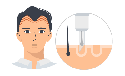 植毛する場所によって株分します。