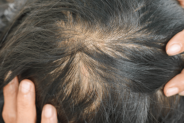 びまん性脱毛症の治療方法は？