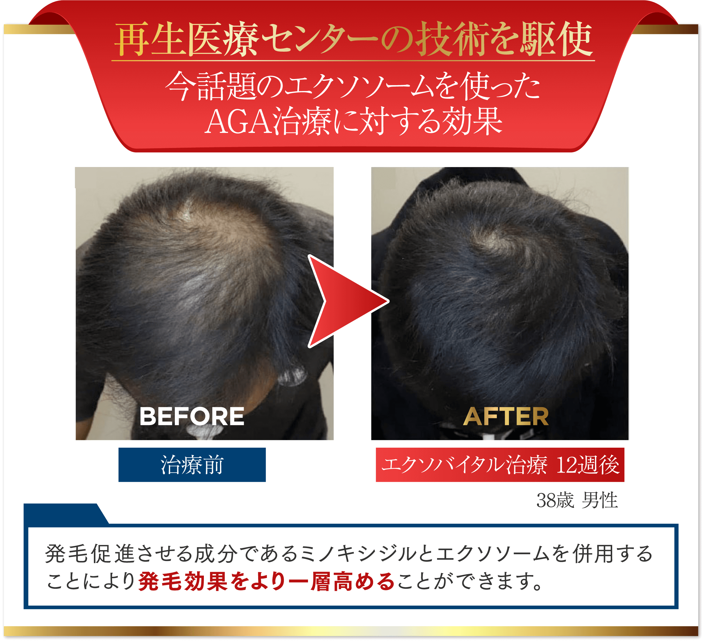 再生医療センターの技術を駆使 今、注目を集める「エクソソーム」を使用したAGAスキンクリニックのオリジナル治療がスタート!