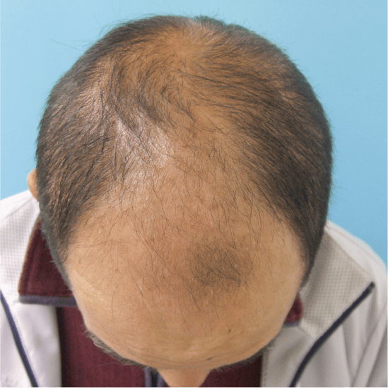 Amazon.co.jp: AGA Male Hair Loss and Thinning Risk Test Kit [Hair Hormone  Volume Measurement Kit] Dihydrotestosterone Hair Growth Before  Countermeasures : Beauty