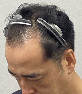 植毛完全ガイド : 世界のスタンダードFUT治療の流れ : 最新版 最新版 植毛完全ガイド―世界のスタンダードFUT治療の流れ | 今川