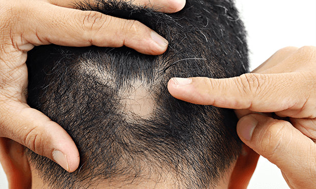 【医師監修】円形脱毛症の原因と種類、治療方法とは？