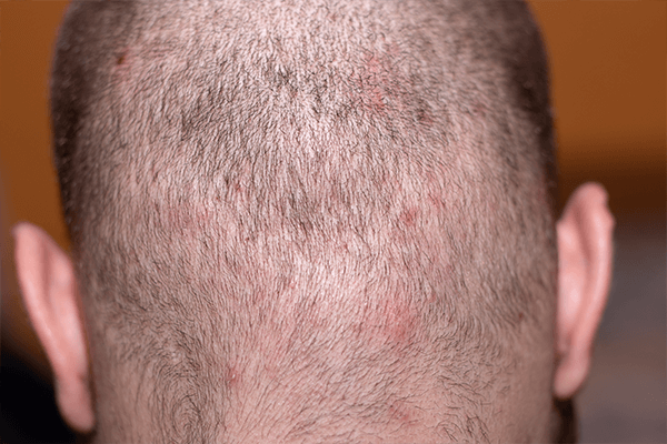 頭皮湿疹の原因とは？頭皮のかゆみ予防&対処法をご紹介