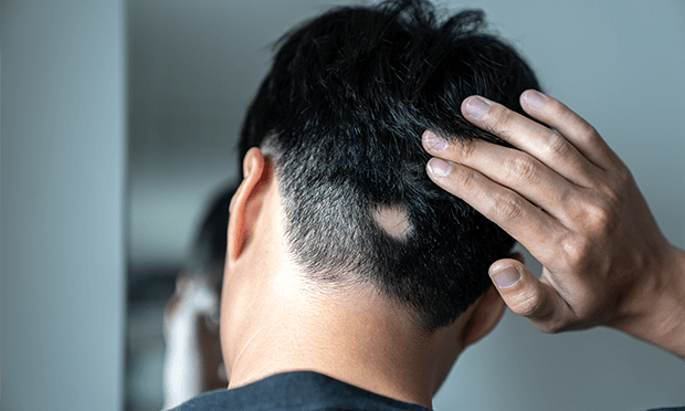 円形脱毛症の原因とは？なりやすい人の特徴や治す方法について解説