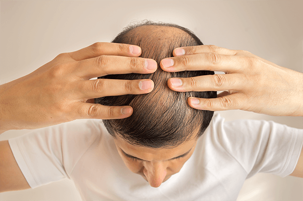 実際プロペシアを飲んで髪は生える？どれくらいの量・期間飲めば抜け毛は改善する？