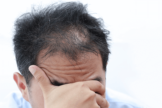男性の抜け毛の原因・特徴