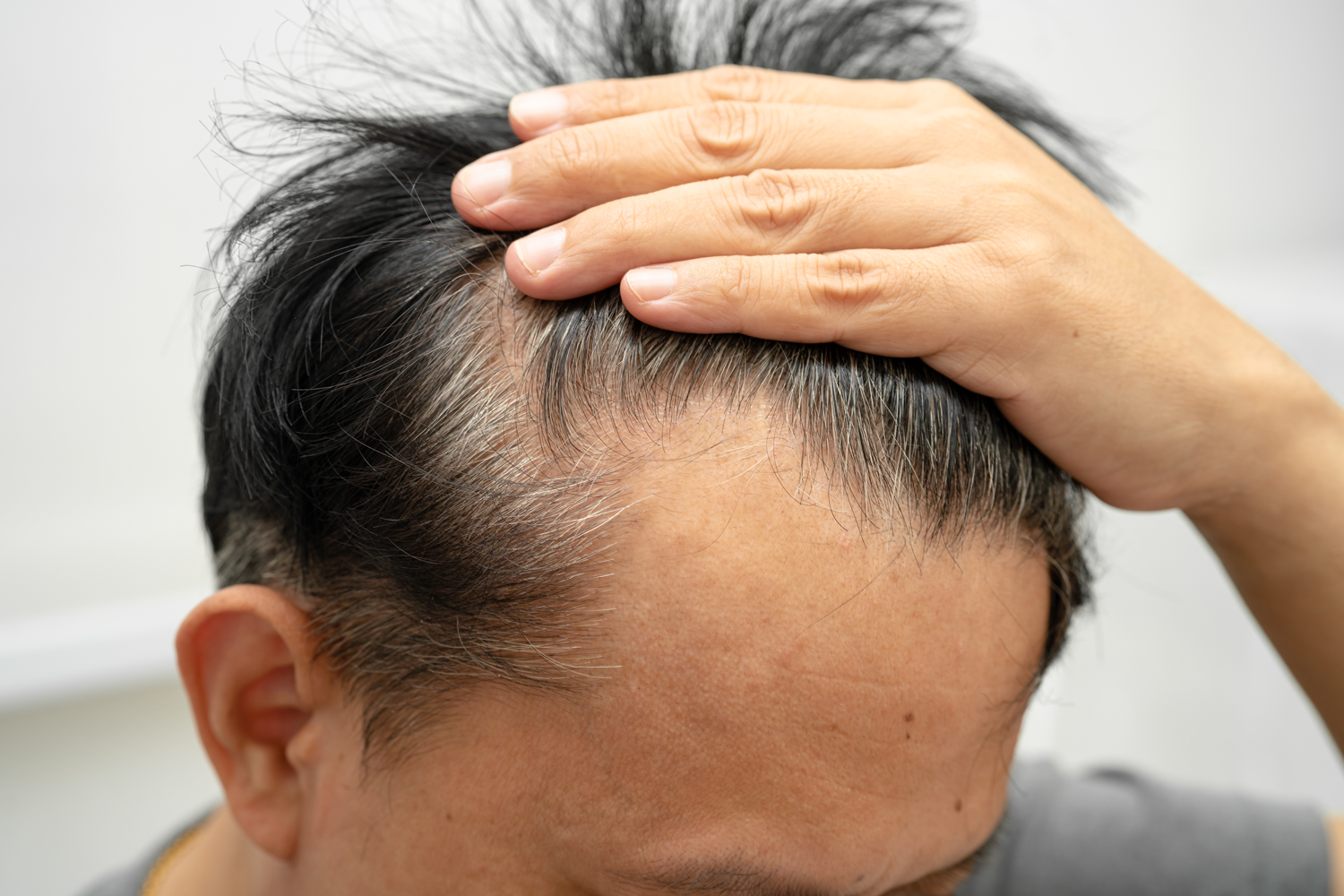 【医師監修】M字ハゲは治らない？原因とセルフチェック、対策方法を解説